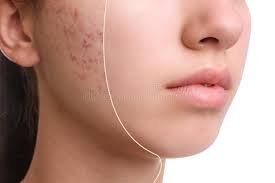 Acne skin treatment